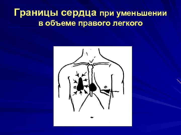 Границы сердца при уменьшении в объеме правого легкого 