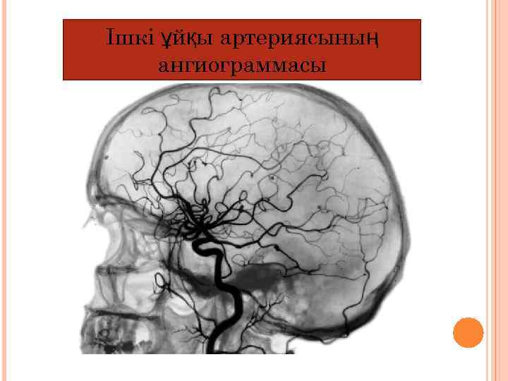 Ішкі ұйқы артериясының ангиограммасы 