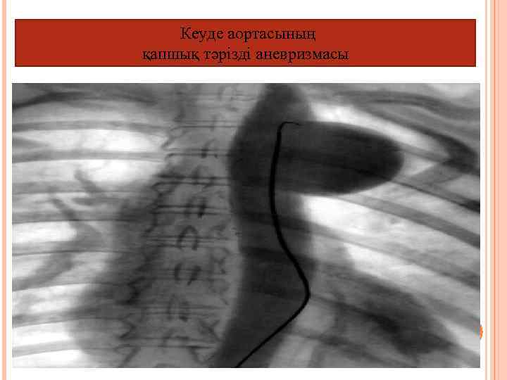 Кеуде аортасының қапшық тәрізді аневризмасы 