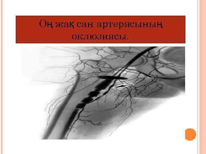 Оң жақ сан артерясының оклюзиясы. 