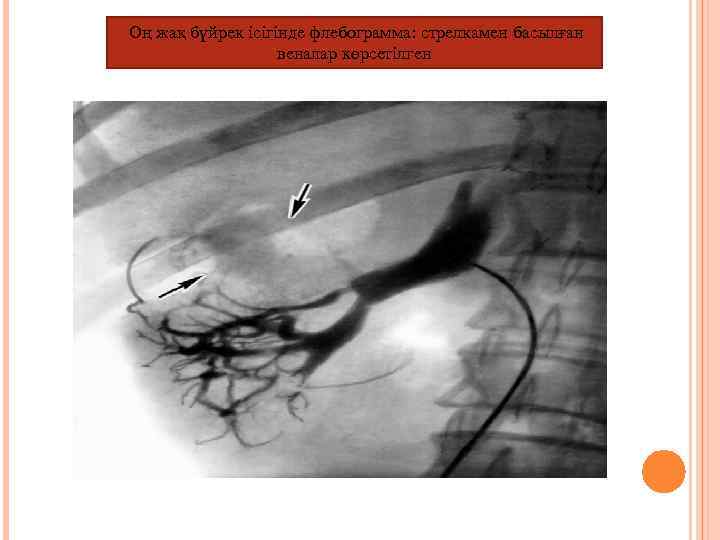 Оң жақ бүйрек ісігінде флебограмма: стрелкамен басылған веналар көрсетілген 