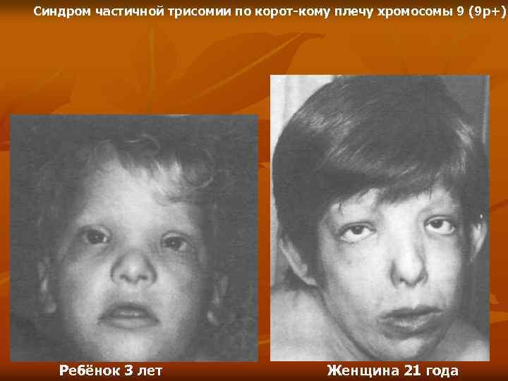 Синдром частичной трисомии по корот кому плечу хромосомы 9 (9 р+) Ребёнок 3 лет