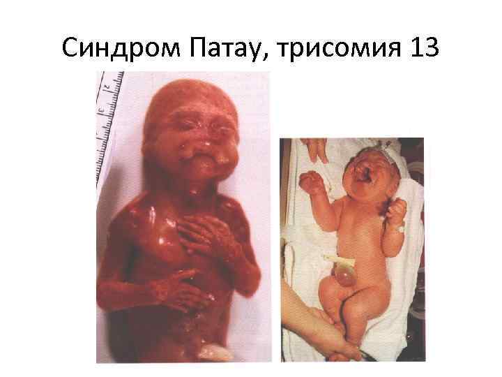 Синдром Патау, трисомия 13 