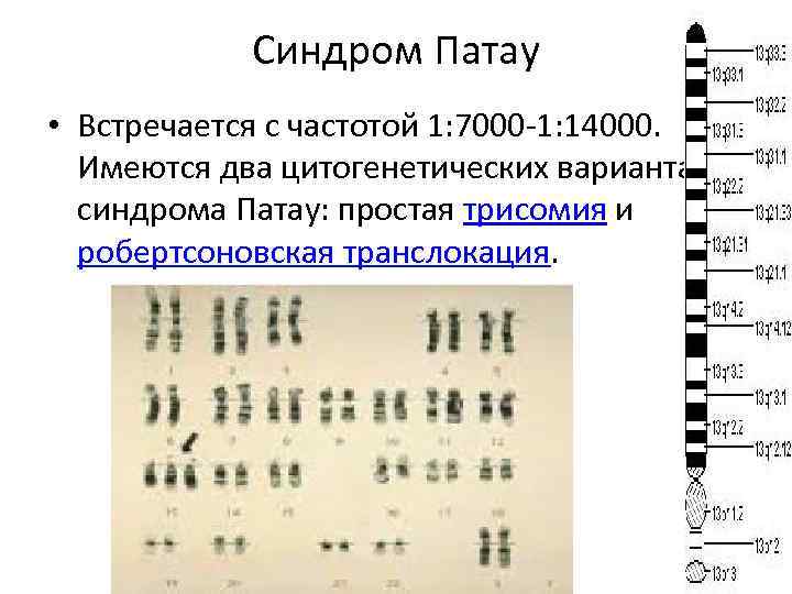 Синдром Патау • Встречается с частотой 1: 7000 1: 14000. Имеются два цитогенетических варианта