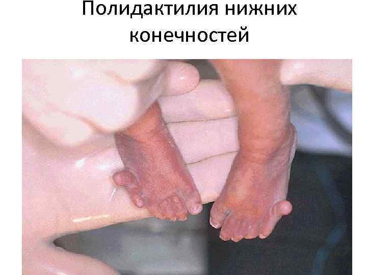 Полидактилия нижних конечностей 