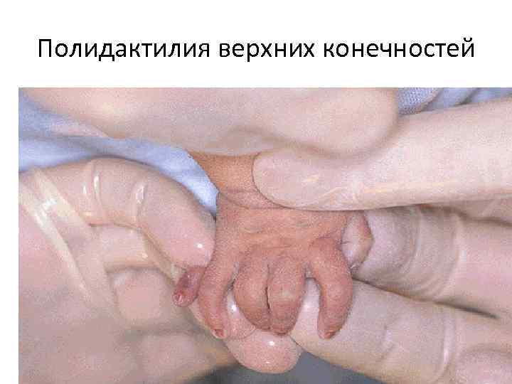 Полидактилия верхних конечностей 
