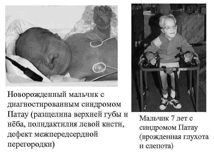 Новорожденный мальчик с диагностированным синдромом Патау (разщелина верхней губы и нёба, полидактилия левой кисти,