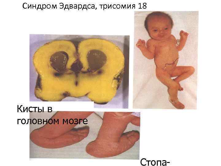 Синдром Эдвардса, трисомия 18 Кисты в головном мозге Стопа 