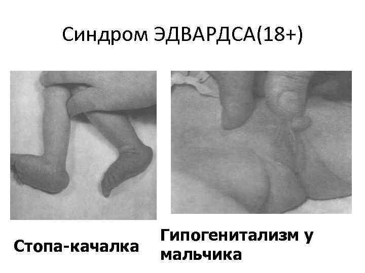 Синдром ЭДВАРДСА(18+) Стопа качалка Гипогенитализм у мальчика 