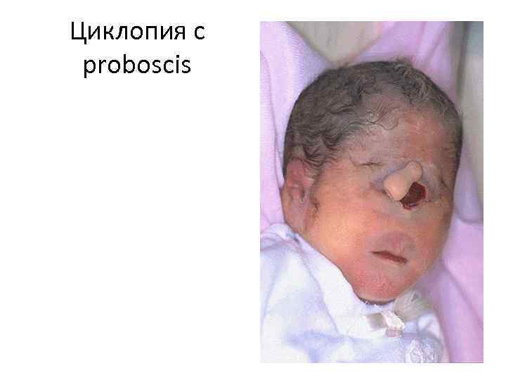 Циклопия с proboscis 