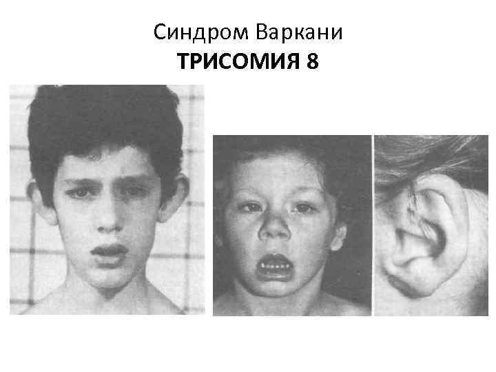 Синдром Варкани ТРИСОМИЯ 8 