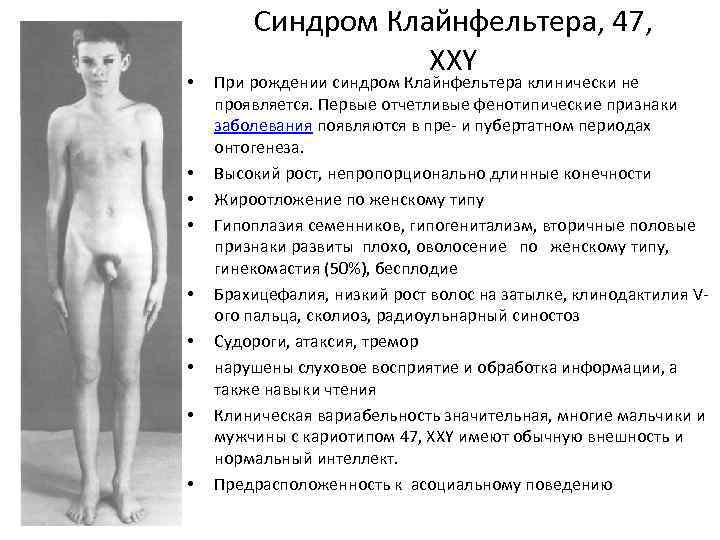  • • • Синдром Клайнфельтера, 47, XXY При рождении синдром Клайнфельтера клинически не