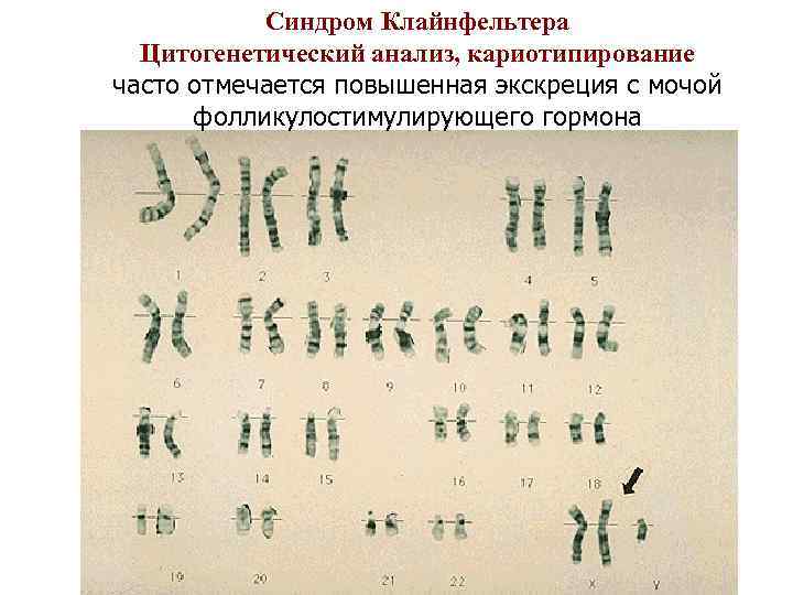 Синдром Клайнфельтера Цитогенетический анализ, кариотипирование часто отмечается повышенная экскреция с мочой фолликулостимулирующего гормона 