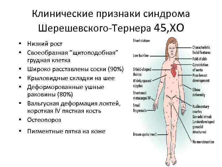 Клинические признаки синдрома Шерешевского Тернера 45, ХО • Низкий рост • Своеобразная “щитоподобная” грудная