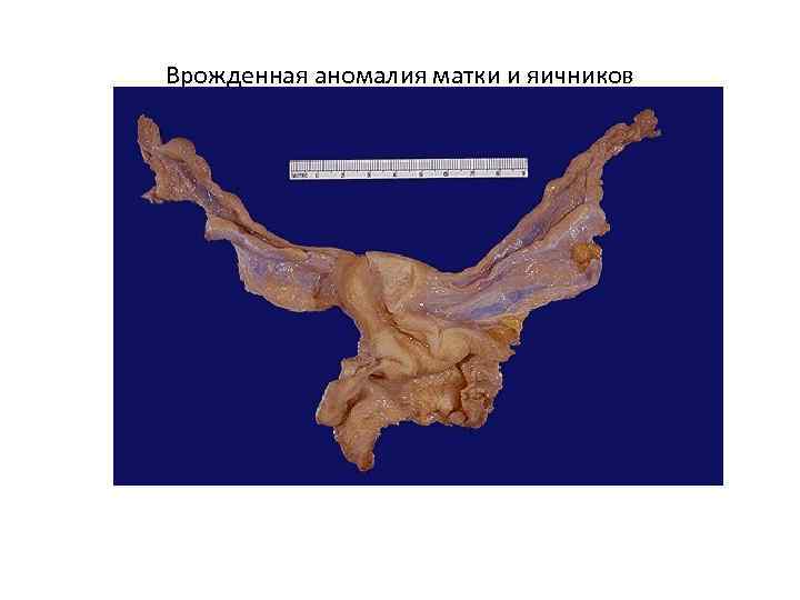 Врожденная аномалия матки и яичников 