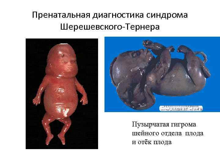 Пренатальная диагностика синдрома Шерешевского Тернера Пузырчатая гигрома шейного отдела плода и отёк плода 