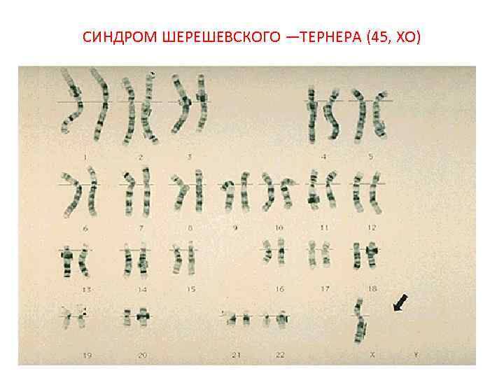 СИНДРОМ ШЕРЕШЕВСКОГО —ТЕРНЕРА (45, ХО) 
