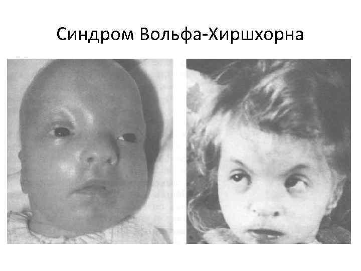 Синдром Вольфа Хиршхорна 