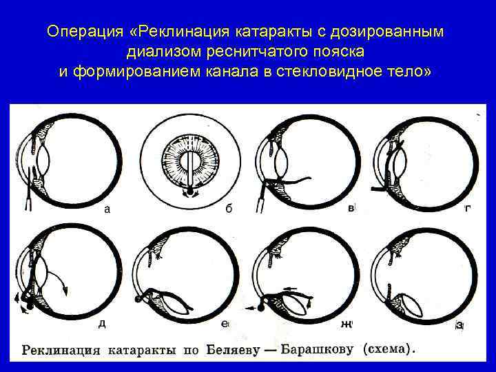 Операция «Реклинация катаракты с дозированным диализом реснитчатого пояска и формированием канала в стекловидное тело»