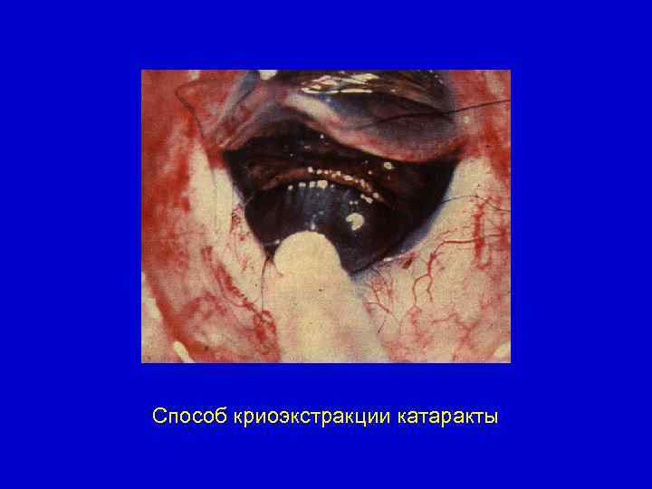 Способ криоэкстракции катаракты 