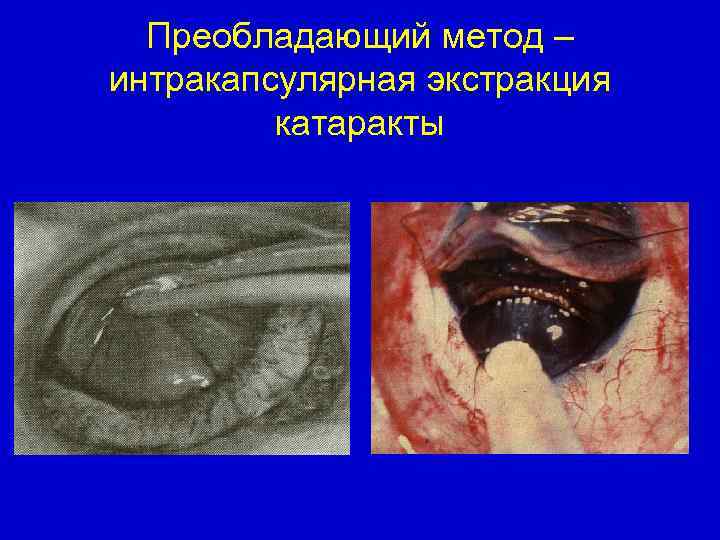 Преобладающий метод – интракапсулярная экстракция катаракты 