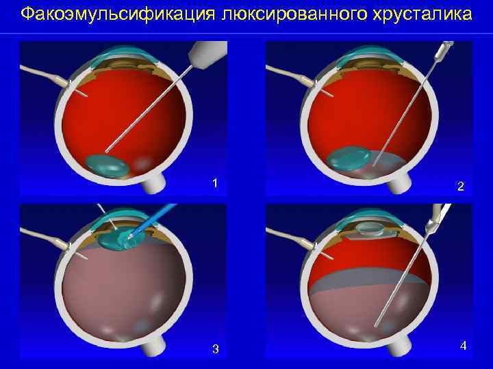 Факоэмульсификация люксированного хрусталика 1 2 3 4 