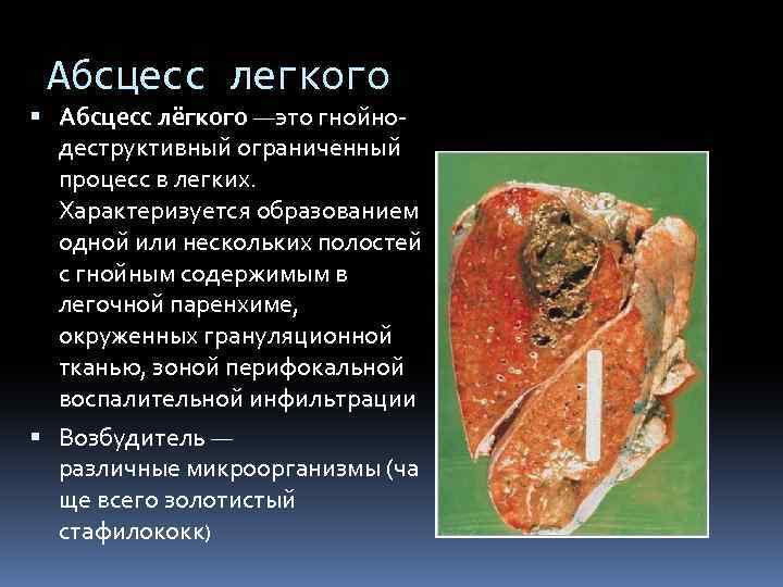 Абсцесс легкого Абсцесс лёгкого —это гнойнодеструктивный ограниченный процесс в легких. Характеризуется образованием одной или