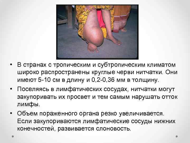  • В странах с тропическим и субтропическим климатом широко распространены круглые черви нитчатки.