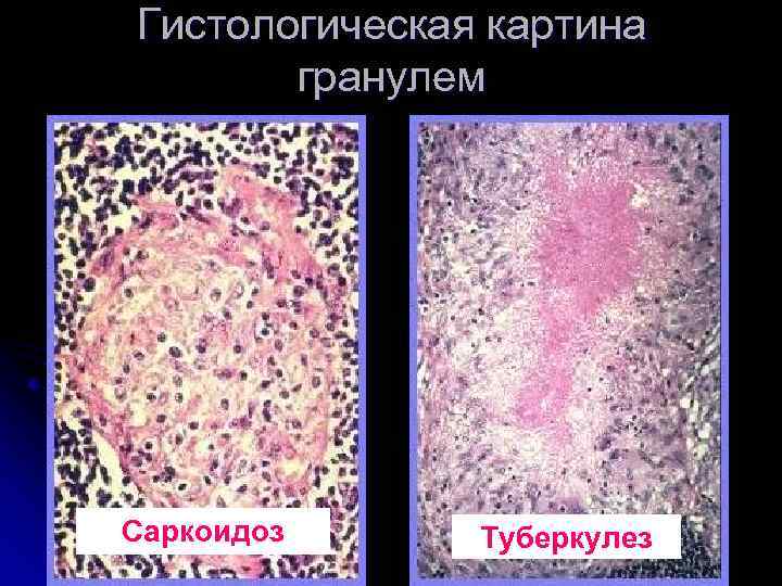 Гистологическая картина гранулем Саркоидоз Туберкулез 