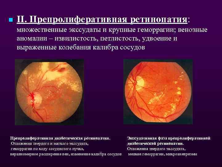 n II. Препролиферативная ретинопатия: множественные экссудаты и крупные геморрагии; венозные аномалии – извилистость, петлистость,