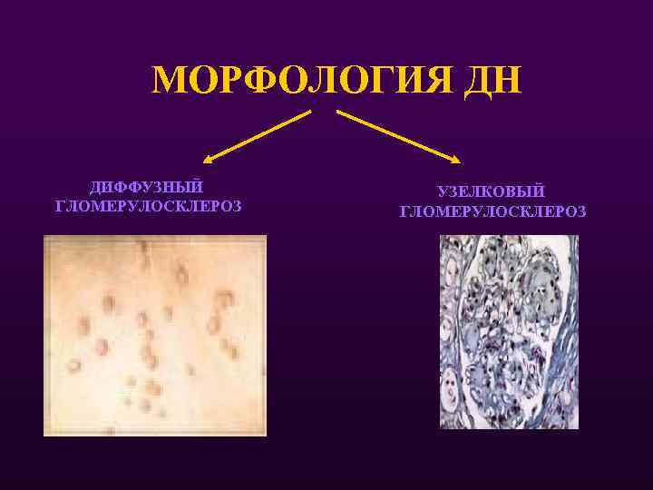 МОРФОЛОГИЯ ДН ДИФФУЗНЫЙ ГЛОМЕРУЛОСКЛЕРОЗ УЗЕЛКОВЫЙ ГЛОМЕРУЛОСКЛЕРОЗ 