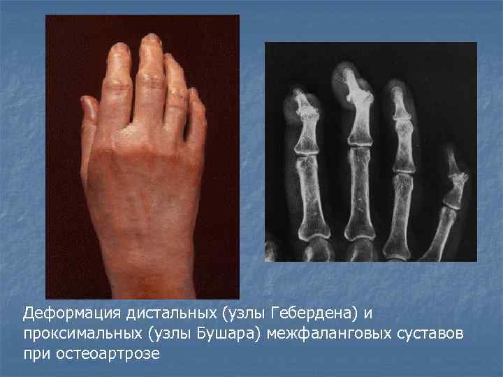 Деформация дистальных (узлы Гебердена) и проксимальных (узлы Бушара) межфаланговых суставов при остеоартрозе 