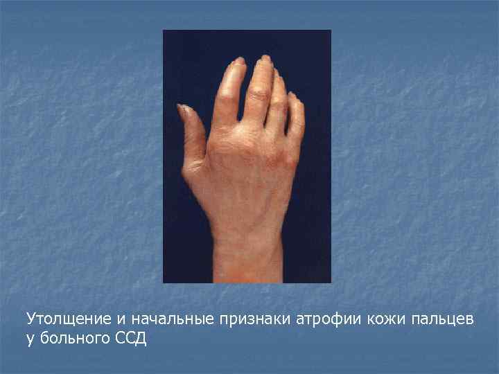 Утолщение и начальные признаки атрофии кожи пальцев у больного ССД 