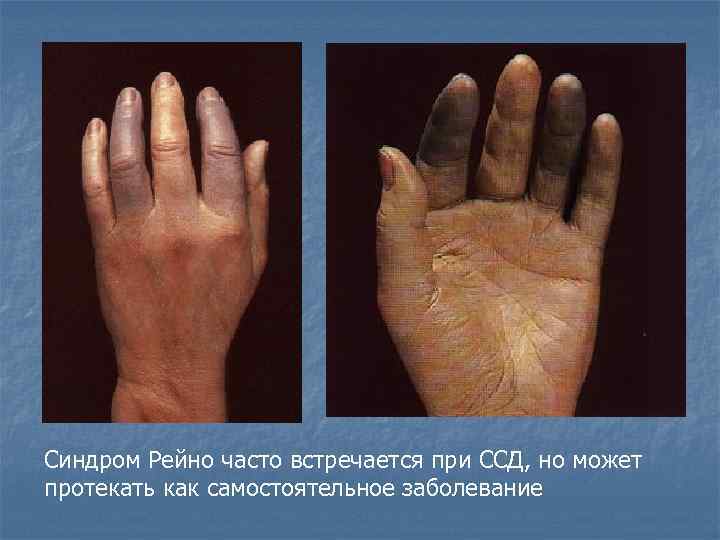 Синдром Рейно часто встречается при ССД, но может протекать как самостоятельное заболевание 