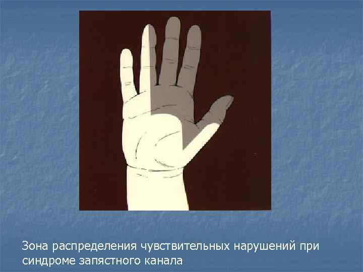 Зона распределения чувствительных нарушений при синдроме запястного канала 