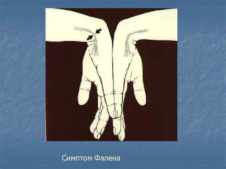 Симптом Фалена 