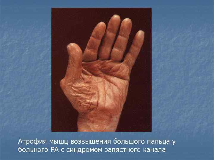 Атрофия мышц возвышения большого пальца у больного РА с синдромом запястного канала 