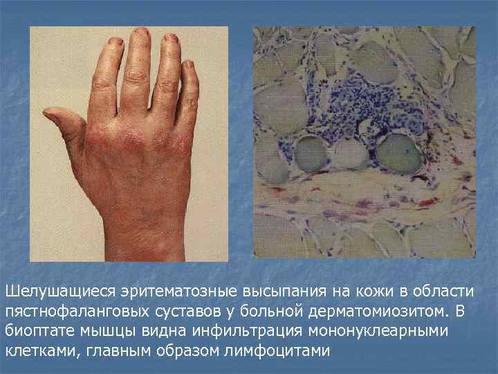 Шелушащиеся эритематозные высыпания на кожи в области пястнофаланговых суставов у больной дерматомиозитом. В биоптате