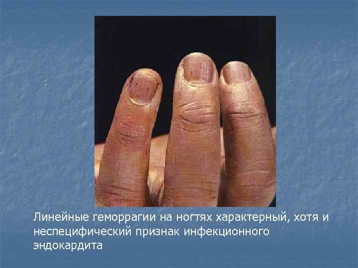 Линейные геморрагии на ногтях характерный, хотя и неспецифический признак инфекционного эндокардита 