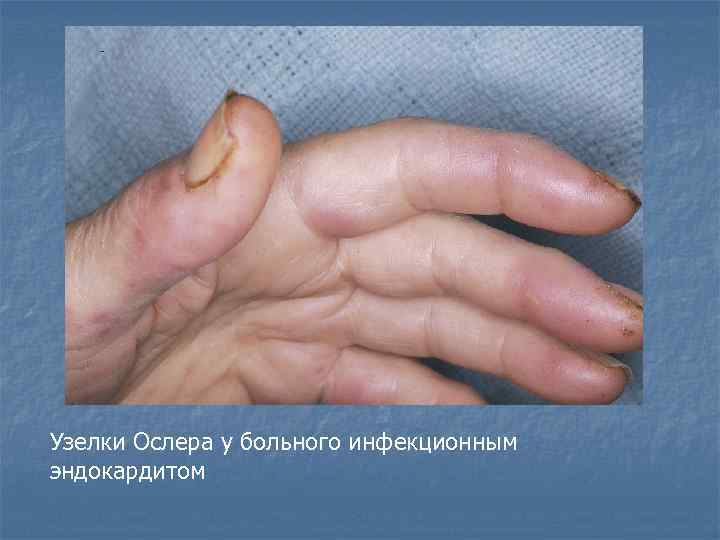 Узелки Ослера у больного инфекционным эндокардитом 