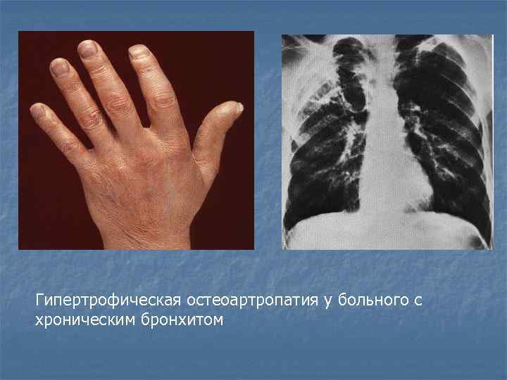 Гипертрофическая остеоартропатия у больного с хроническим бронхитом 