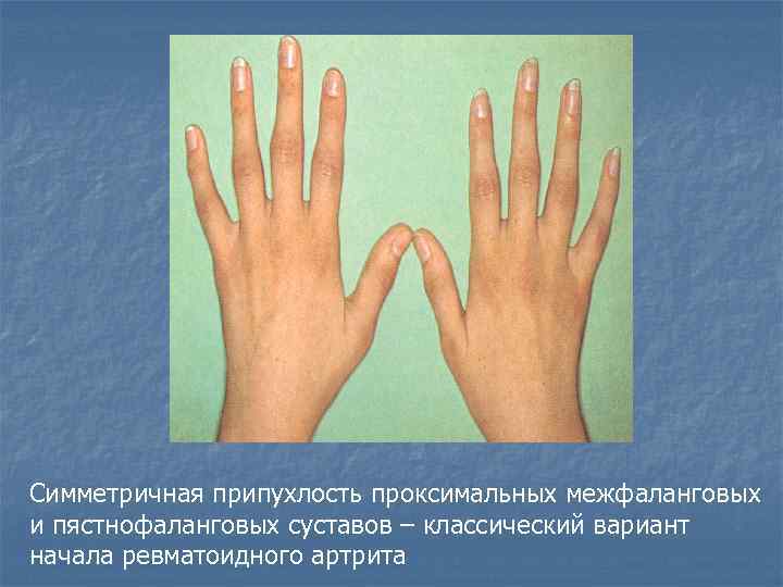 Симметричная припухлость проксимальных межфаланговых и пястнофаланговых суставов – классический вариант начала ревматоидного артрита 