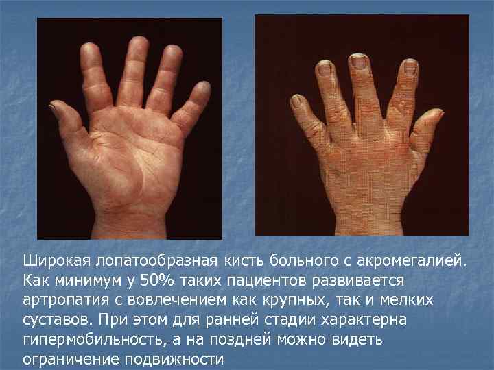 Широкая лопатообразная кисть больного с акромегалией. Как минимум у 50% таких пациентов развивается артропатия