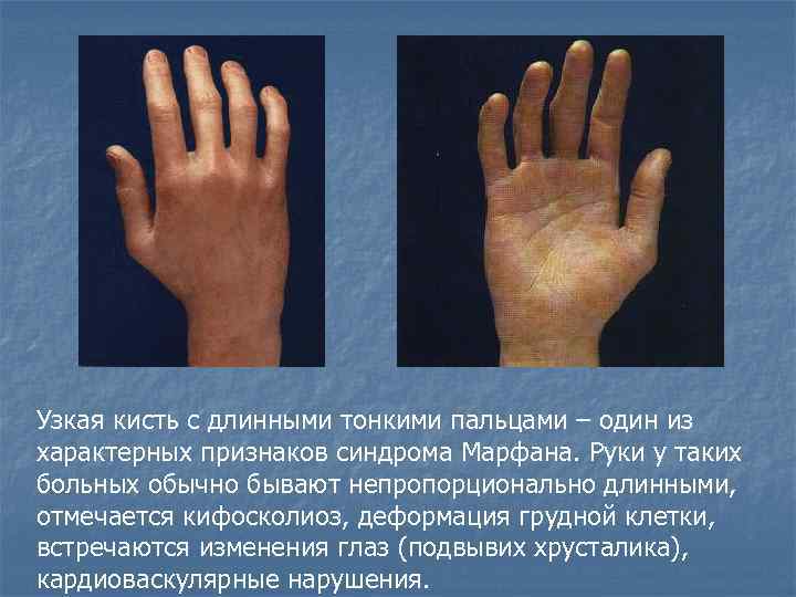 Узкая кисть с длинными тонкими пальцами – один из характерных признаков синдрома Марфана. Руки
