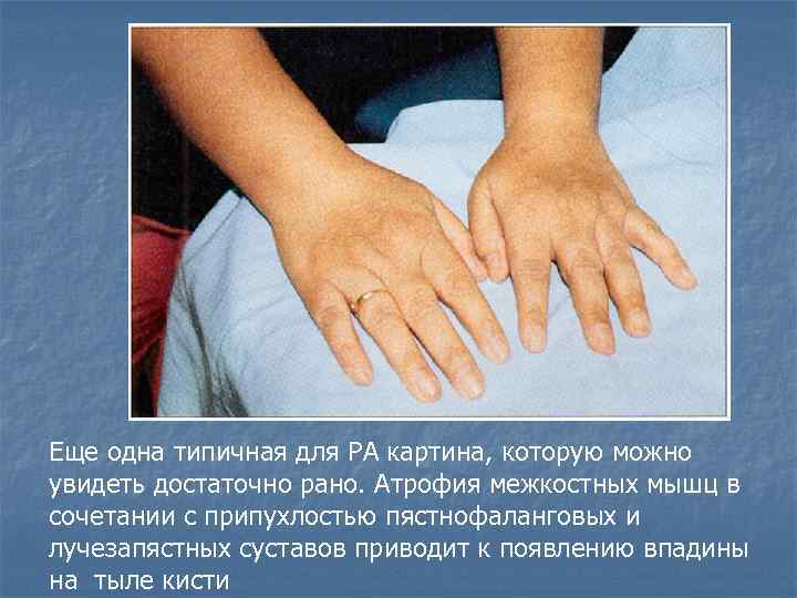 Еще одна типичная для РА картина, которую можно увидеть достаточно рано. Атрофия межкостных мышц