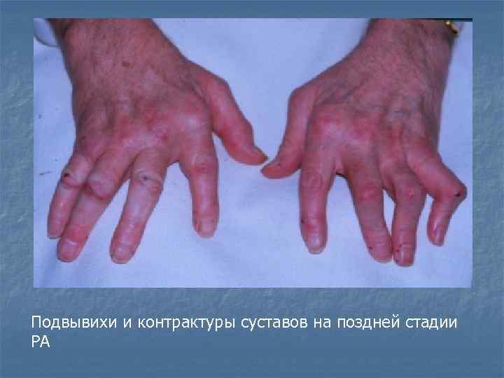 Подвывихи и контрактуры суставов на поздней стадии РА 
