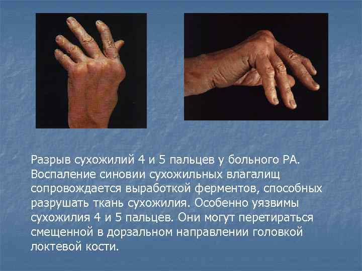 Разрыв сухожилий 4 и 5 пальцев у больного РА. Воспаление синовии сухожильных влагалищ сопровождается
