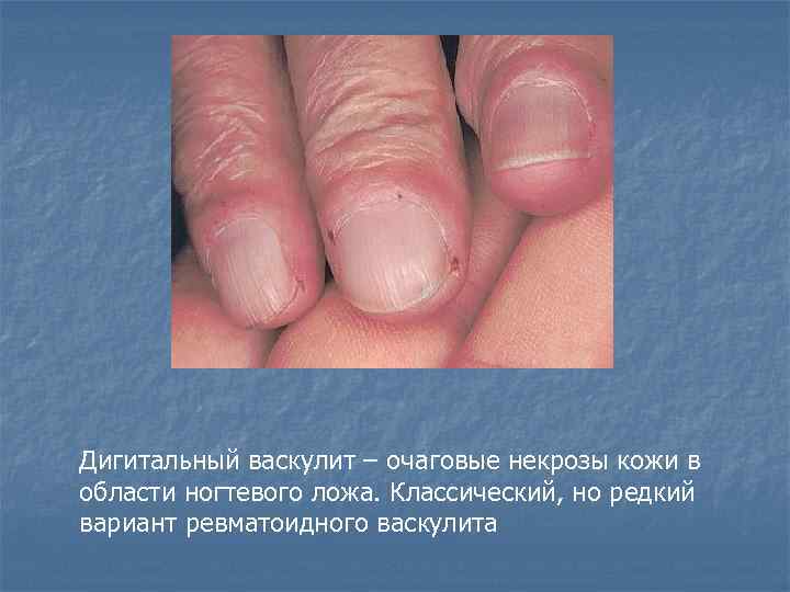 Дигитальный васкулит – очаговые некрозы кожи в области ногтевого ложа. Классический, но редкий вариант