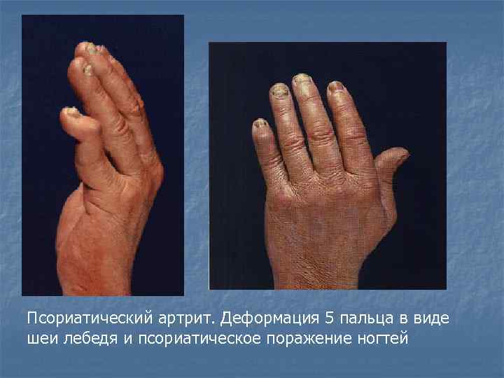 Псориатический артрит. Деформация 5 пальца в виде шеи лебедя и псориатическое поражение ногтей 