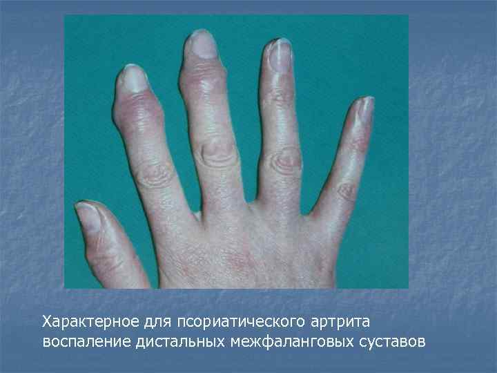 Характерное для псориатического артрита воспаление дистальных межфаланговых суставов 